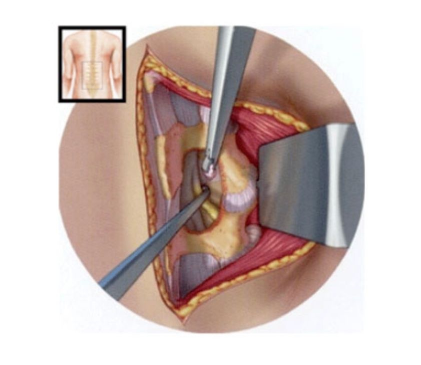 Cirurgia para Hérnia de Disco em Goiânia
