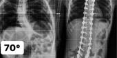 Escoliose Neuromuscular em Goiânia - Cirurgia para Escoliose - Dr. Vinicio Nunes Nascimento