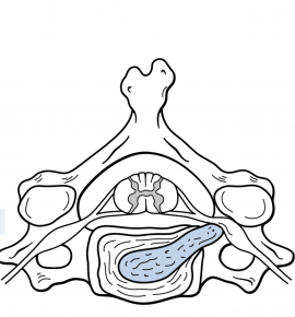 Coluna Vertebral - Hérnia de Disco Cervical